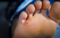 What Are the Treatments for Foot Corns?