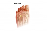 Facts About Morton's Neuroma